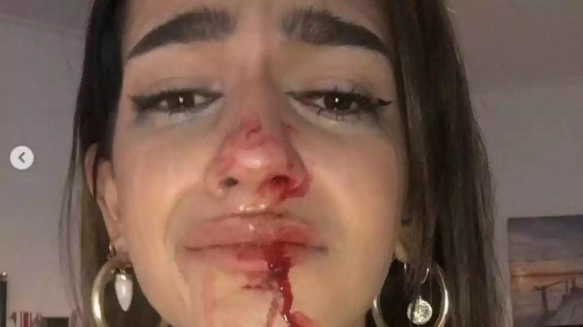 Una de las fotos de después de la agresión que la joven colgó en sus redes sociales