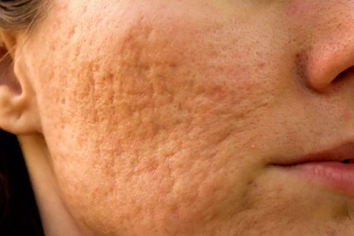 Una cara con marcas de acné en primerísimo plano y algunos granos